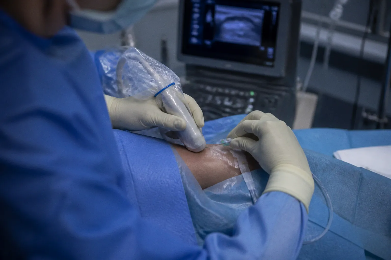 Optimiser l'analgésie : le cathéter périnerveux comme outil de neurostimulation